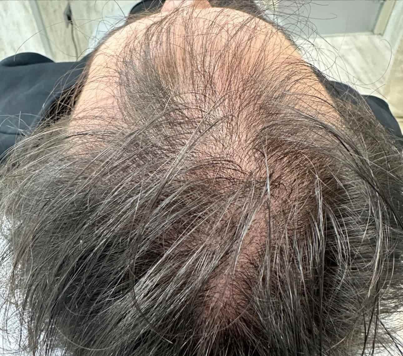 antes-mesoterapia-capilar