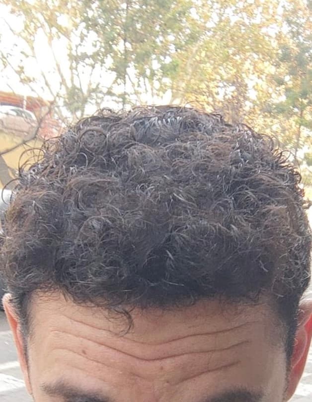 despues-injerto-capilar
